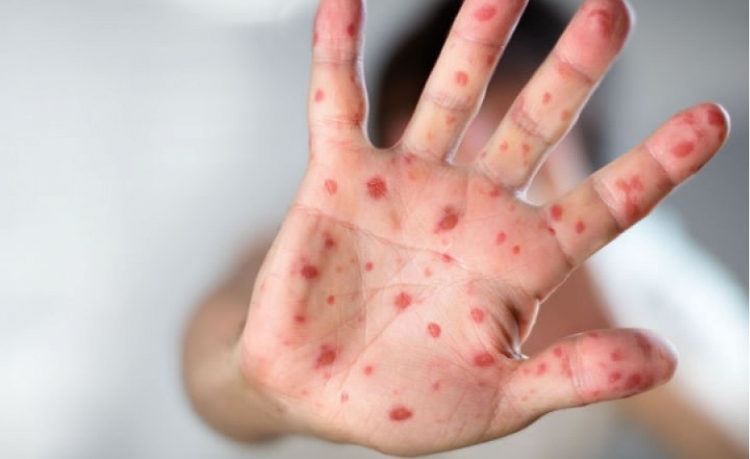 Sarampión en Argentina